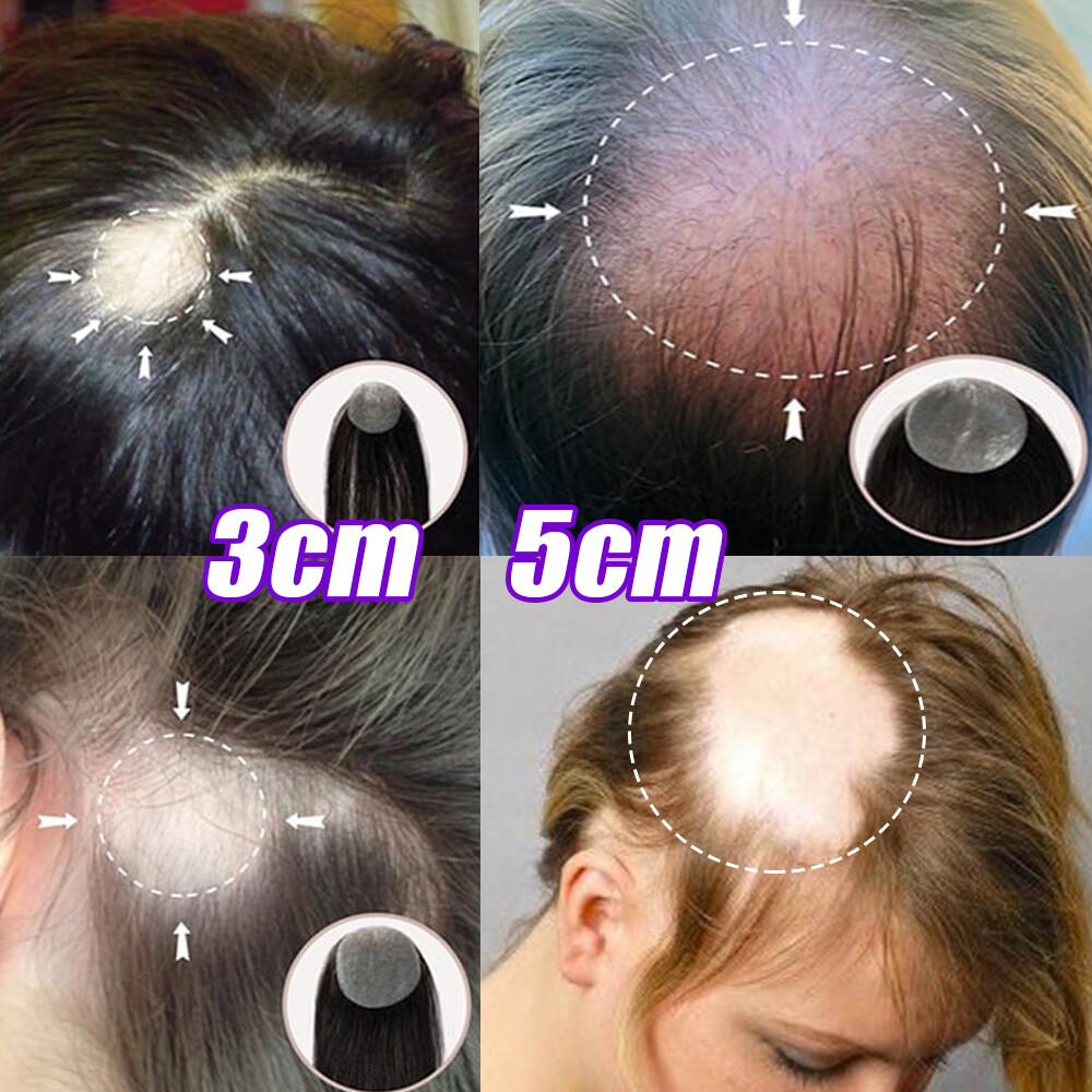 Full Lace / Skin Cover-up Human Hair Patches Patch Hairpiece for Alopecia Areata