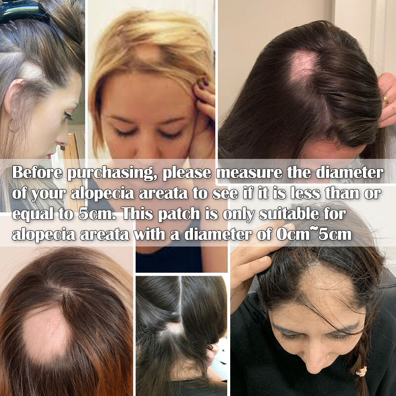 Human Hair Patch Full Lace Cover-up Topper Hairpiece for Women’s Alopecia Areata