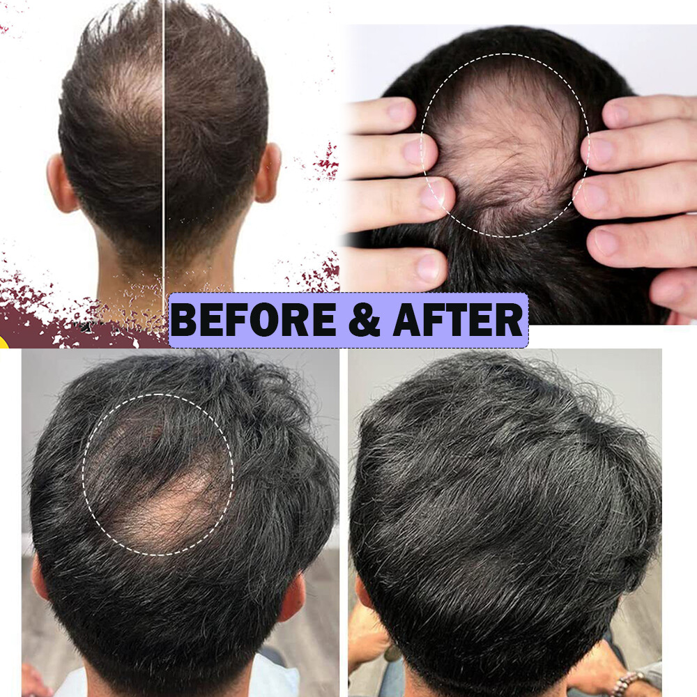 Men Frontal Hairline Temple Hair Patch Remy Human Hair Cover up Topper Bald Spot