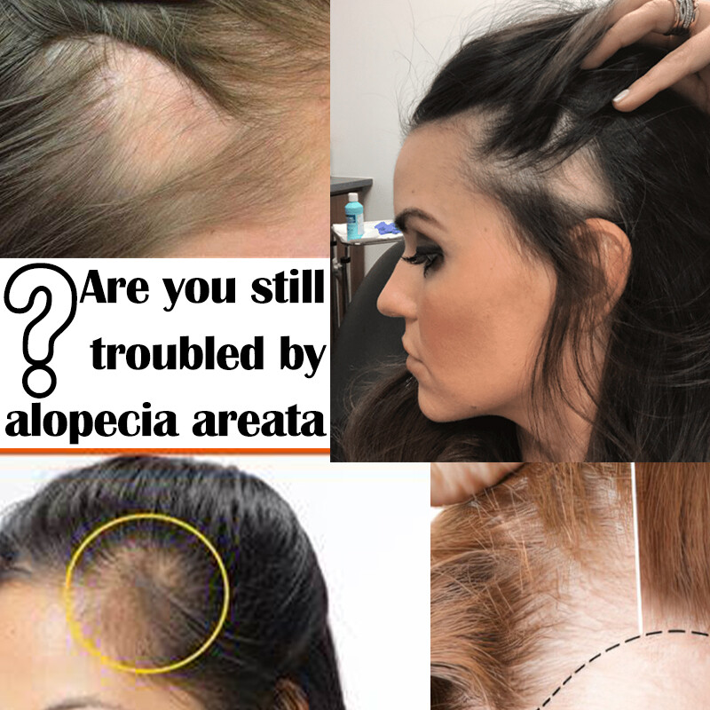 100% Human Hair Patch, Full Thin Skin Base Cover-up One Pieces for Hair Loss